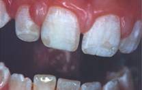macchie fluoro fluorosi displasia smalto denti sbiancamento professionale dentista